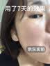 KEORKAO祛痘药膏去痘痘淡化痘印消炎痤疮专用祛痘精华青少年青春痘试用装 实拍图