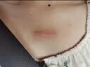 BKWILD医用重组生长因子凝胶胶原蛋白点痣喷人表祛疤痕膏修复生肌膏 实拍图