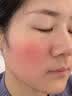 Newliann医用冷敷贴面膜械字号敷料重组胶原蛋白晒后修复医美术后补水保湿 实拍图