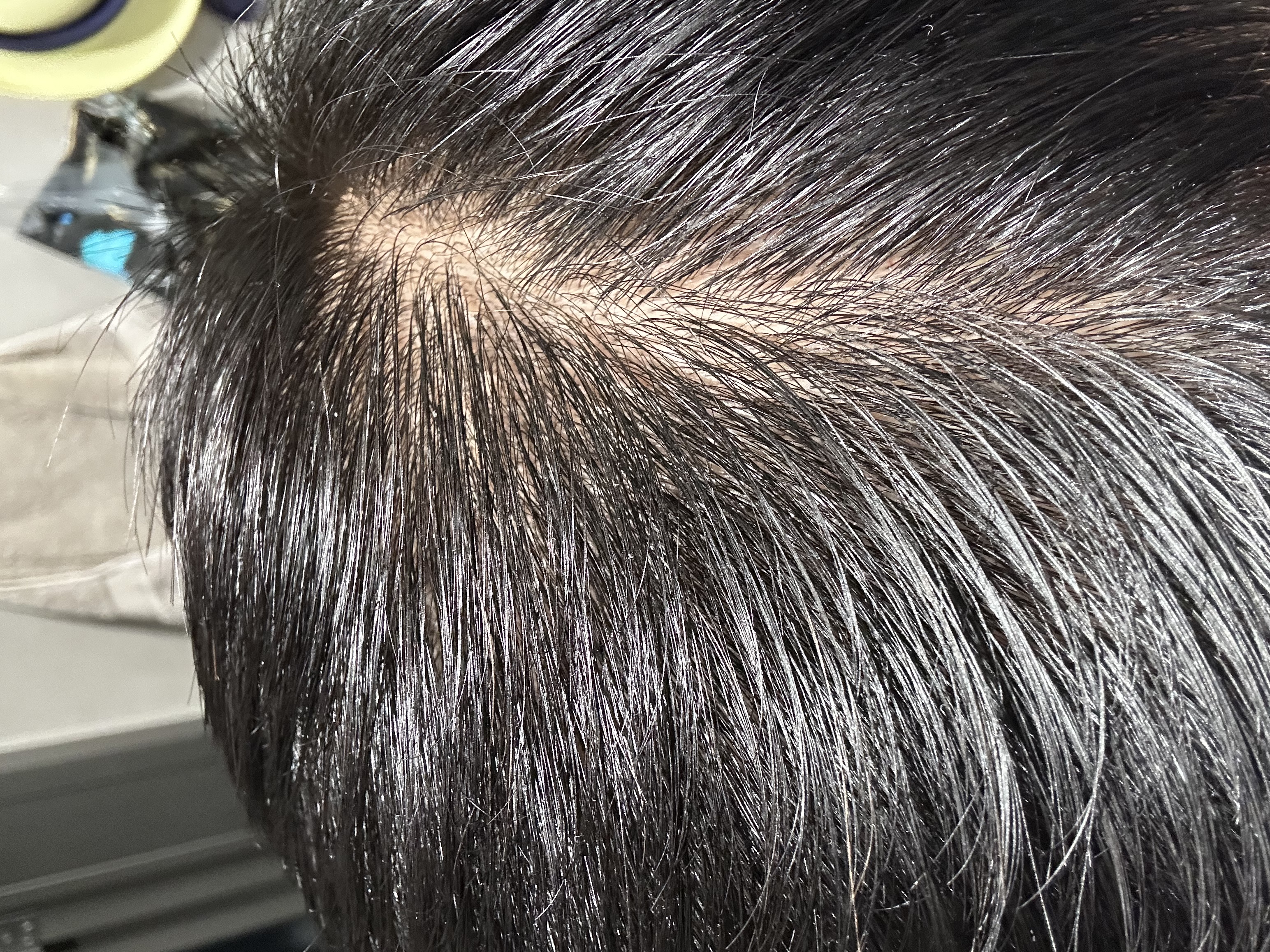 蔓迪【独家获批】蔓迪二代米诺地尔5%生发泡沫剂60g*3男女专用治脱发防脱洗发水育发米洛酊搽剂 实拍图