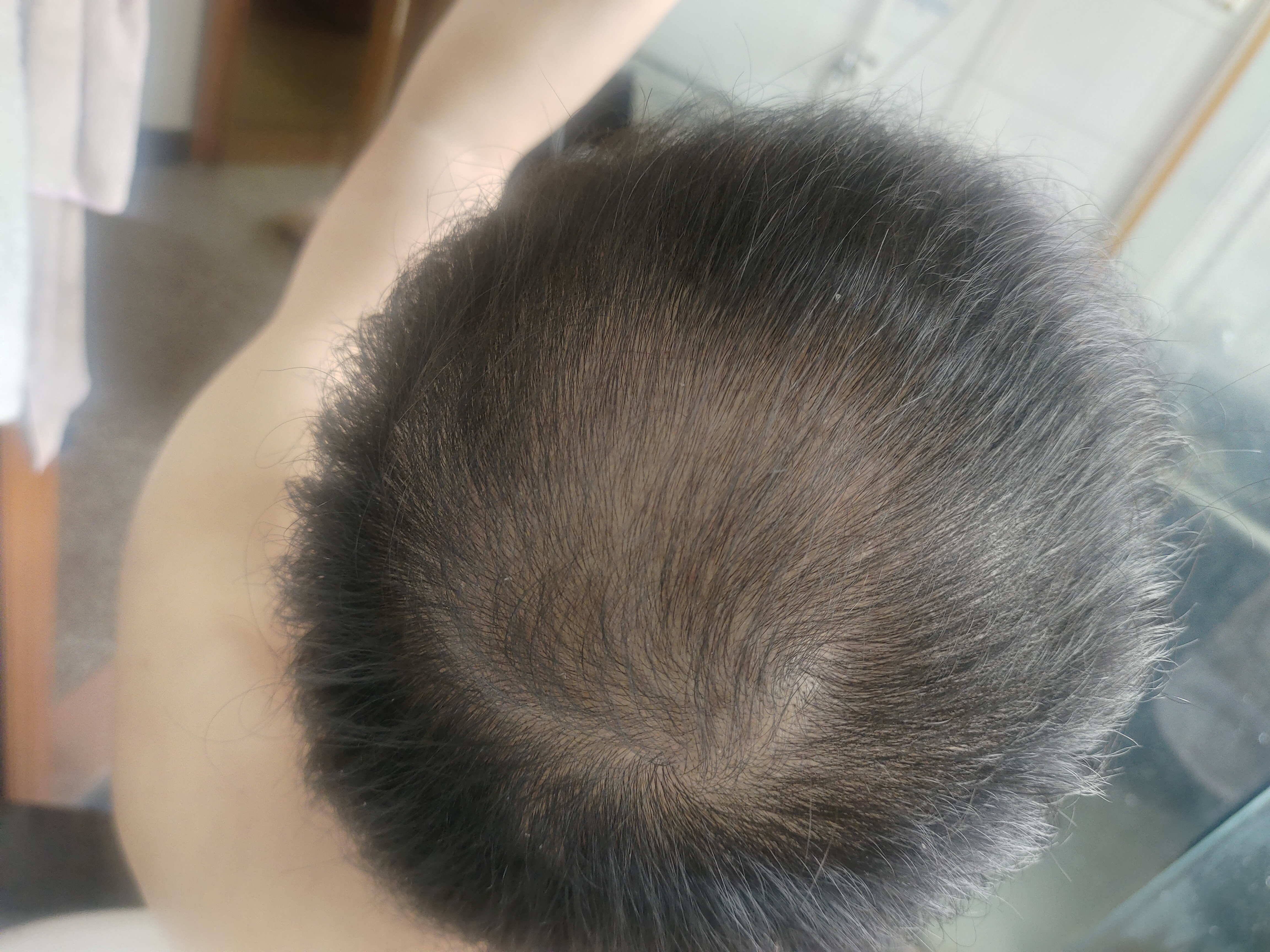 蔓迪生发喷雾5%米诺地尔酊90ml*2瓶男士专用治脱发育发斑秃原液搽剂曼迪京东自营米洛地尔生发剂 实拍图