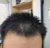 蔓迪【独家获批】蔓迪二代米诺地尔5%生发泡沫剂60g男士专用治脱发防脱洗发水育发米洛原液酊搽剂 实拍图