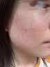 维特丝水杨酸祛痘精华淡化痘印去痘痘收毛孔男女护肤青春期学生专用30g 实拍图