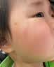 KEORKAO美国进口硅酮祛疤膏儿童去疤痕修复凝胶小孩专用除去疤膏手术 实拍图