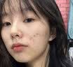 OHBT壬二酸15%凝胶祛痘药乳膏水杨酸霜青春痘学生祛痘印淡痘印坑消炎 实拍图