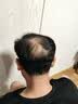 蔓迪【独家获批】蔓迪二代米诺地尔5%生发泡沫剂60g男士专用治脱发防脱洗发水育发米洛原液酊搽剂 实拍图