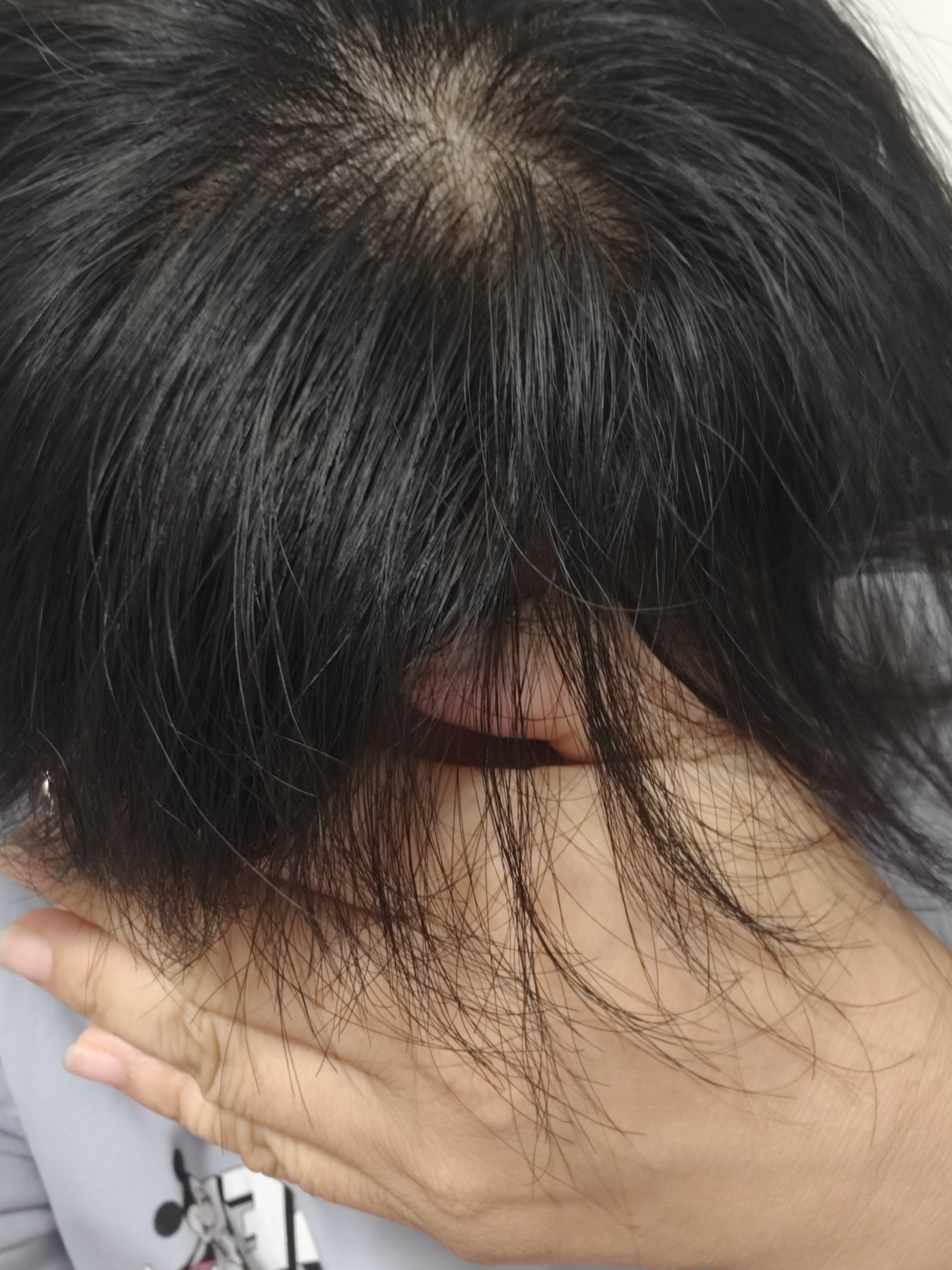 硬核医生 米诺地尔酊5%*30ml 治疗男女性专用治脱发和斑秃严重脱发生发液药防脱喷雾搽剂育发溶液皮肤用药 实拍图