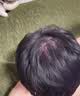 蔓迪生发喷雾5%米诺地尔酊90ml*2瓶男士专用治脱发育发斑秃原液搽剂曼迪京东自营米洛地尔生发剂 实拍图