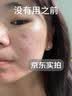 KEORKAO祛痘药膏去痘痘淡化痘印消炎痤疮专用祛痘精华青少年青春痘试用装 实拍图