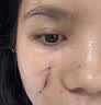 KELICES祛疤克痕祛疤膏去疤痕修复进口医用硅酮凝胶医院专用手术剖腹产 实拍图