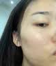 维特丝祛痘膏壬二酸15%凝胶祛痘印青少年专用淡痘印水杨酸胶态硫烟酰胺 实拍图
