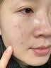 维特丝水杨酸祛痘精华淡化痘印去痘痘收毛孔男女护肤青春期学生专用30g 实拍图