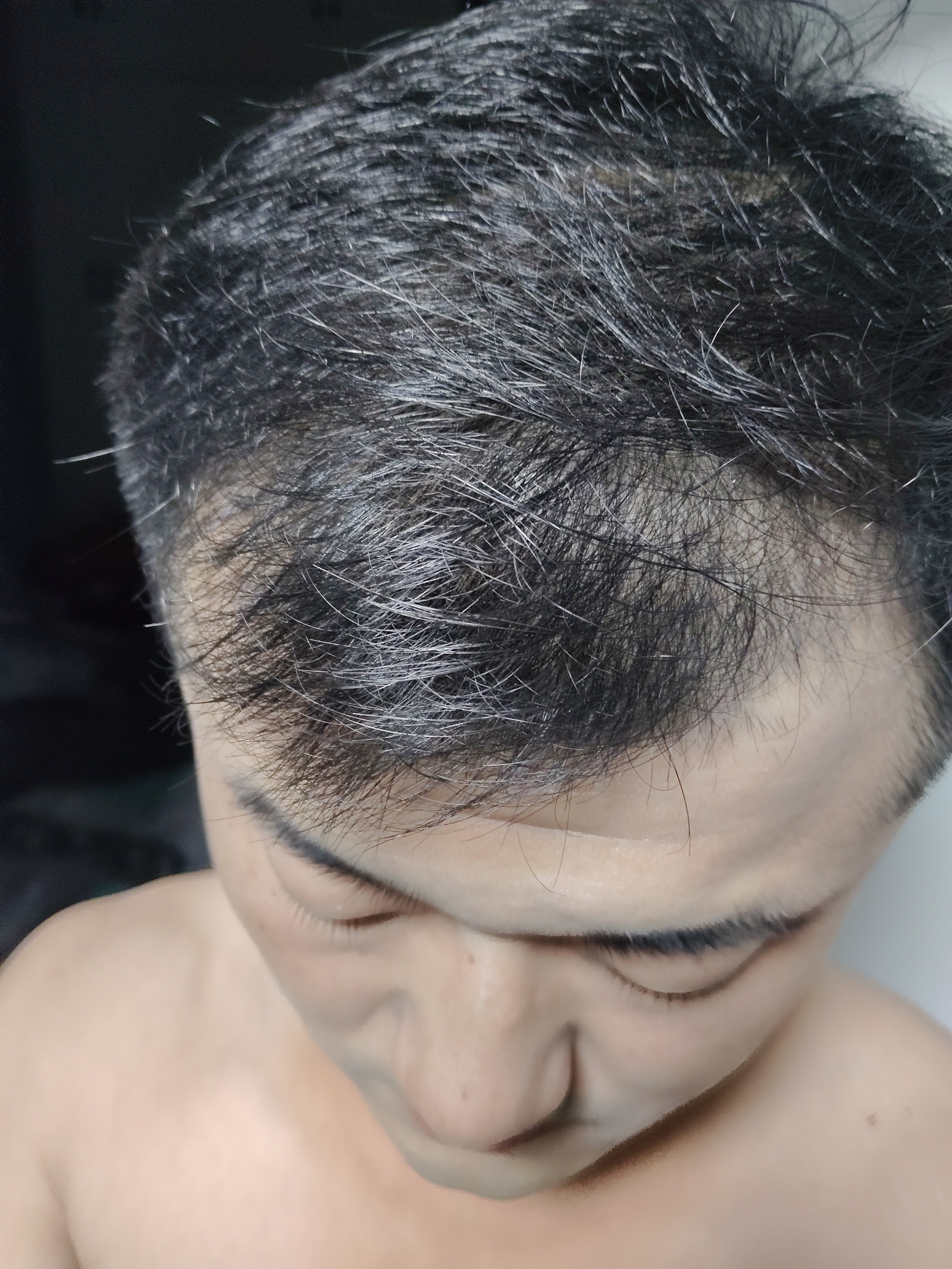 蔓迪【独家获批】蔓迪二代米诺地尔5%生发泡沫剂60g*3男女专用治脱发防脱洗发水育发米洛酊搽剂 实拍图