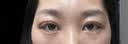 芭克kelocote官方疤克硅胶软膏凝胶祛疤膏去疤淡疤医用6g价同11.11 实拍图