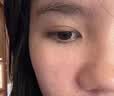 KELICES祛疤克痕祛疤膏去疤痕修复进口医用硅酮凝胶医院专用手术剖腹产 实拍图