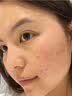 维特丝水杨酸祛痘精华淡化痘印去痘痘收毛孔男女护肤青春期学生专用30g 实拍图