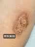 DR.MICKEY褥疮膏老人臀部外用褥疮溃烂生肌去腐长肉愈合伤口压疮生肌膏 实拍图