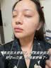 Newliann医用冷敷贴面膜械字号敷料重组胶原蛋白晒后修复医美术后补水保湿 实拍图