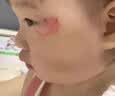澳愈（ORYURE）祛疤膏去疤痕修复儿童医用硅酮疤痕凝胶专用剖腹产手术缝针除疤 实拍图