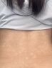 [拜都帮]曲安奈德益康唑乳膏 汗斑花斑癣专用药汗斑专用药(发货特效)真菌感染皮肤用药皮肤白斑汗斑净 15g 5支装 【全身都有斑 不敢出门】 实拍图