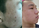 珂语草本植萃苦参根祛痘膏去痘痘和痘印痤疮青春痘青少年学生修护面霜 祛痘膏1瓶+洗脸巾 实拍图
