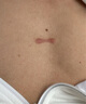 【香港研究院】疤痕膏新老刀疤手术凹凸摔伤烫伤增生疤痘坑痘印黑色素 20g/盒 3盒装 90%人选择 实拍图