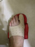 足峰脚趾矫正器拇指外翻矫正器大脚骨纠正器日夜用拇外翻矫形器可穿鞋 肤色一双（左右脚各一只） S（28-32码适用） 实拍图