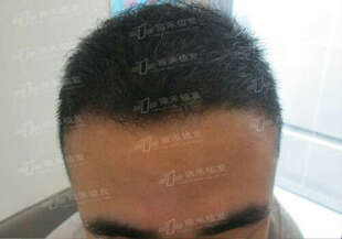 三正医美汇 北京雍禾美度 无痕植发 毛发种植 植