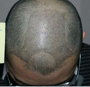 三正医美汇 北京雍禾美度 无痕植发 毛发种植 植