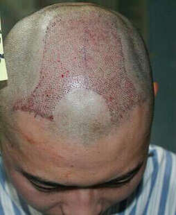 三正医美汇 北京雍禾美度 无痕植发 毛发种植 植