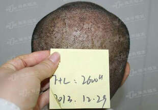 三正医美汇 北京雍禾美度 无痕植发 毛发种植 植