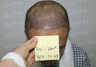 三正医美汇 北京雍禾美度 无痕植发 毛发种植 植