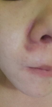 这应该不是吸黑头的，这是拔罐的    都发紫了  购买慎重考虑