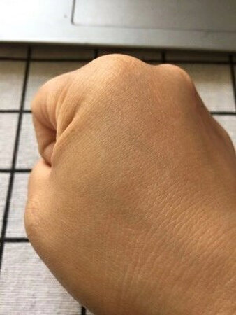 烫伤的伤口，第一张图已经是用了一周后慢慢在脱皮的样子，虽然拍的时候光线不同，但是伤疤确实好了。有效果，会接下来用再膝盖上