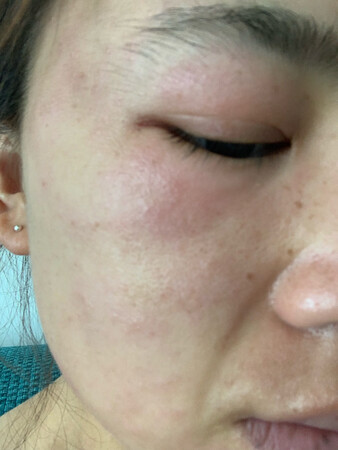 差评，用了严重过敏，脸都肿了，还痒
使用感受：用完很干，直接红肿过敏，起水泡。姐妹们慎用