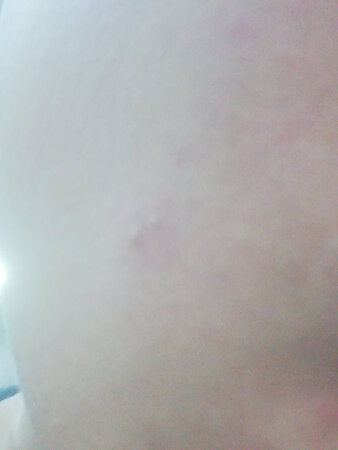 假的吧，昨晚开始用，长了两个大痘痘，局部红。。。。。。。在柜台买的没过敏
朋友推荐来的，后悔～～～～。。。。。