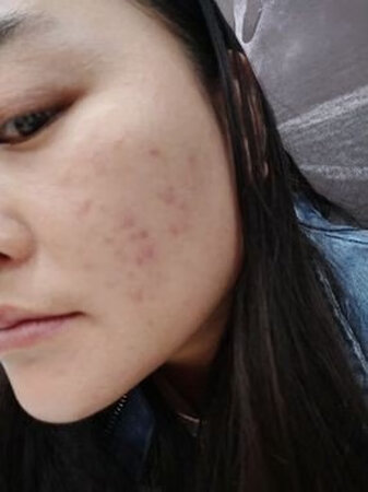 特意用了段时间才来追加，确实好用，以前脸上的痘痘都消了，看着舒服很多，东西确实是好东西，用过这么多修正的是最见效的一个了，现在每天都坚持用，祛痘套装非常好，温和不刺激，脸上的痘淡了许多，真的不错呢。