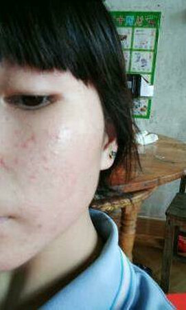 东西抹上感觉很清凉，特别舒适，浓浓的中药味道，温和不刺激，吸收挺好的，保湿滋润效果也不错，用了半个月皮肤改善好多了