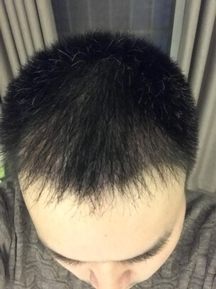 i黑密智能激光生发有用么?用过来诉说下真相?