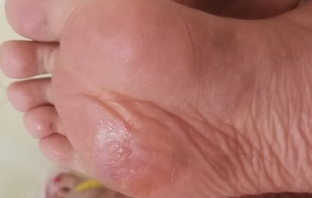 鸡眼贴