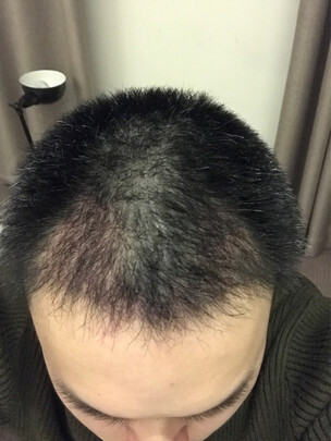 i黑密智能激光生发有用么?用过来诉说下真相?