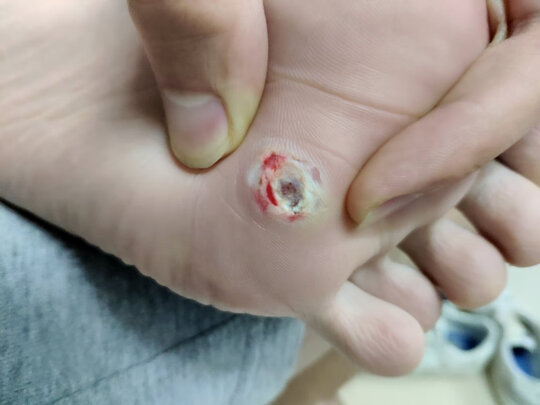 三,李夫人鸡眼贴网友对比评测