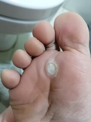 三,云南本草鸡眼贴网友对比评测