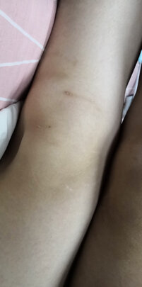 髌骨带