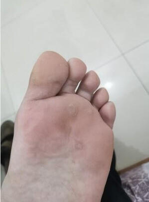 神评测内廷上用6贴鸡眼贴解析?求助大家解密 - 中国建材加盟网