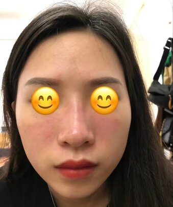 胶原蛋白敷料