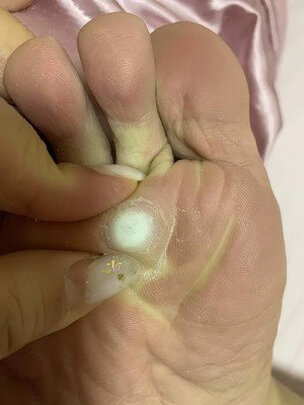 三,内廷上用6贴鸡眼贴网友对比评测