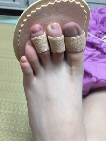 二脚趾弯曲了很多年了.