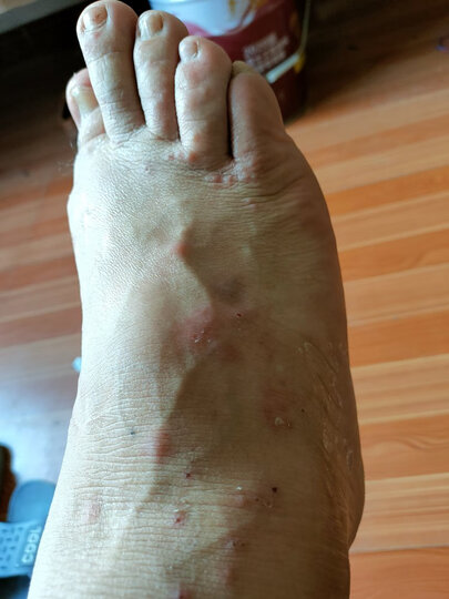 被臭虫咬的妈的太厉害了用它喷了一次感觉少多了好好很多