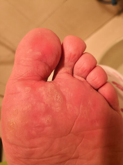 jys脚医生鸡眼膏(跖疣寻常疣鸡眼贴除瘊子肉刺趾疣脚老茧) 12g液态氮